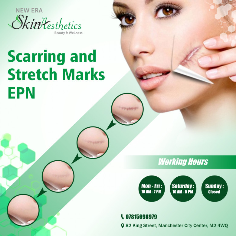 Scarring and Stretch Marks